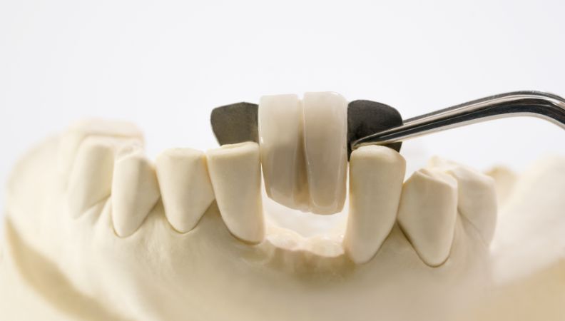 Dental Bridge