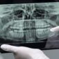can you have mri with dental implants 85x85