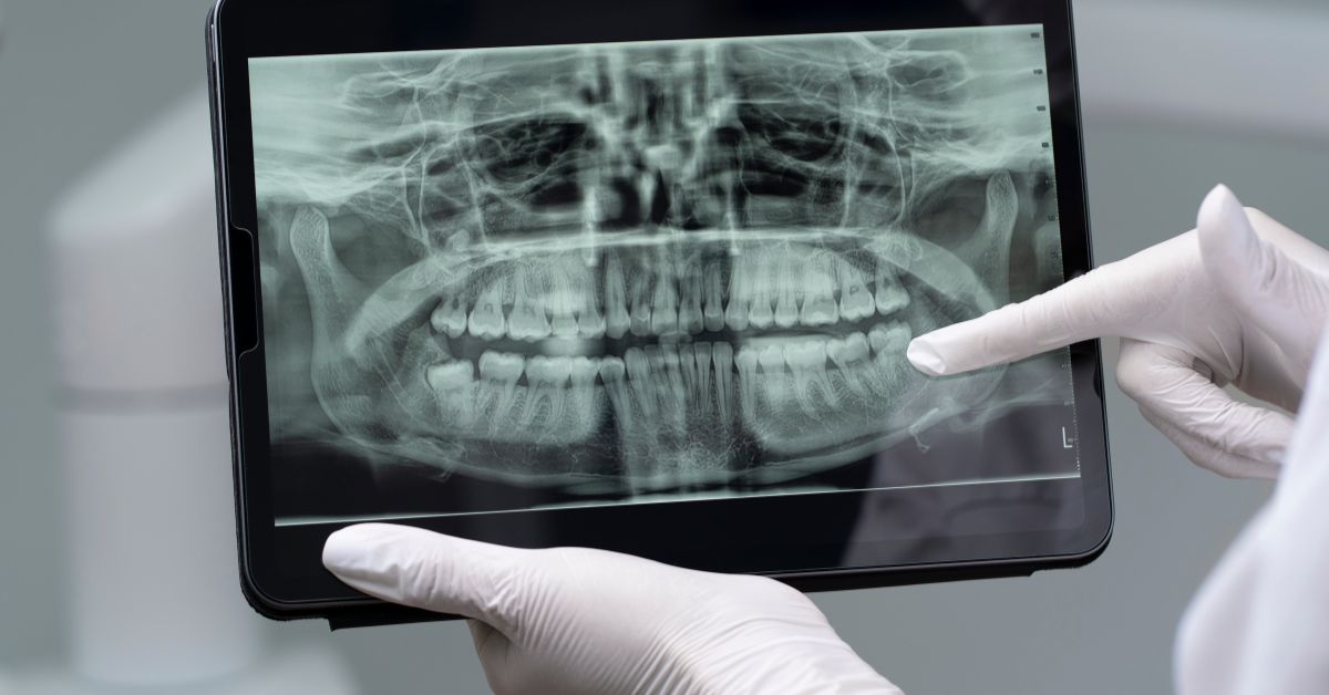 can you have mri with dental implants