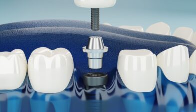 what are dental bridges made of