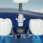 what are dental bridges made of 85x85