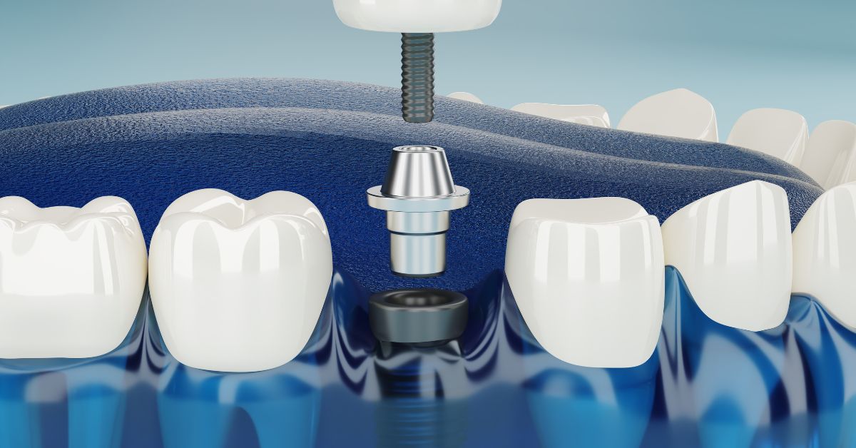 what are dental bridges made of
