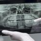 bone graft dental code 85x85