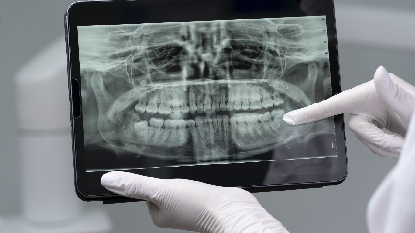 bone graft dental code