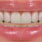 d2740 dental code 85x85