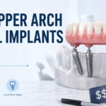 full upper arch dental implants cost